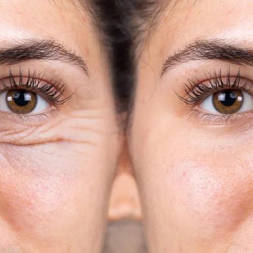 before-after-anti-aging-wrinkle-eye-cream
